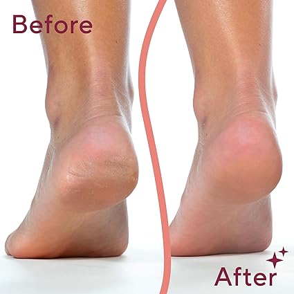 Electric Foot Callus Remover